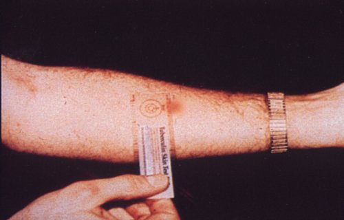 Tuberculosis Test Reactions